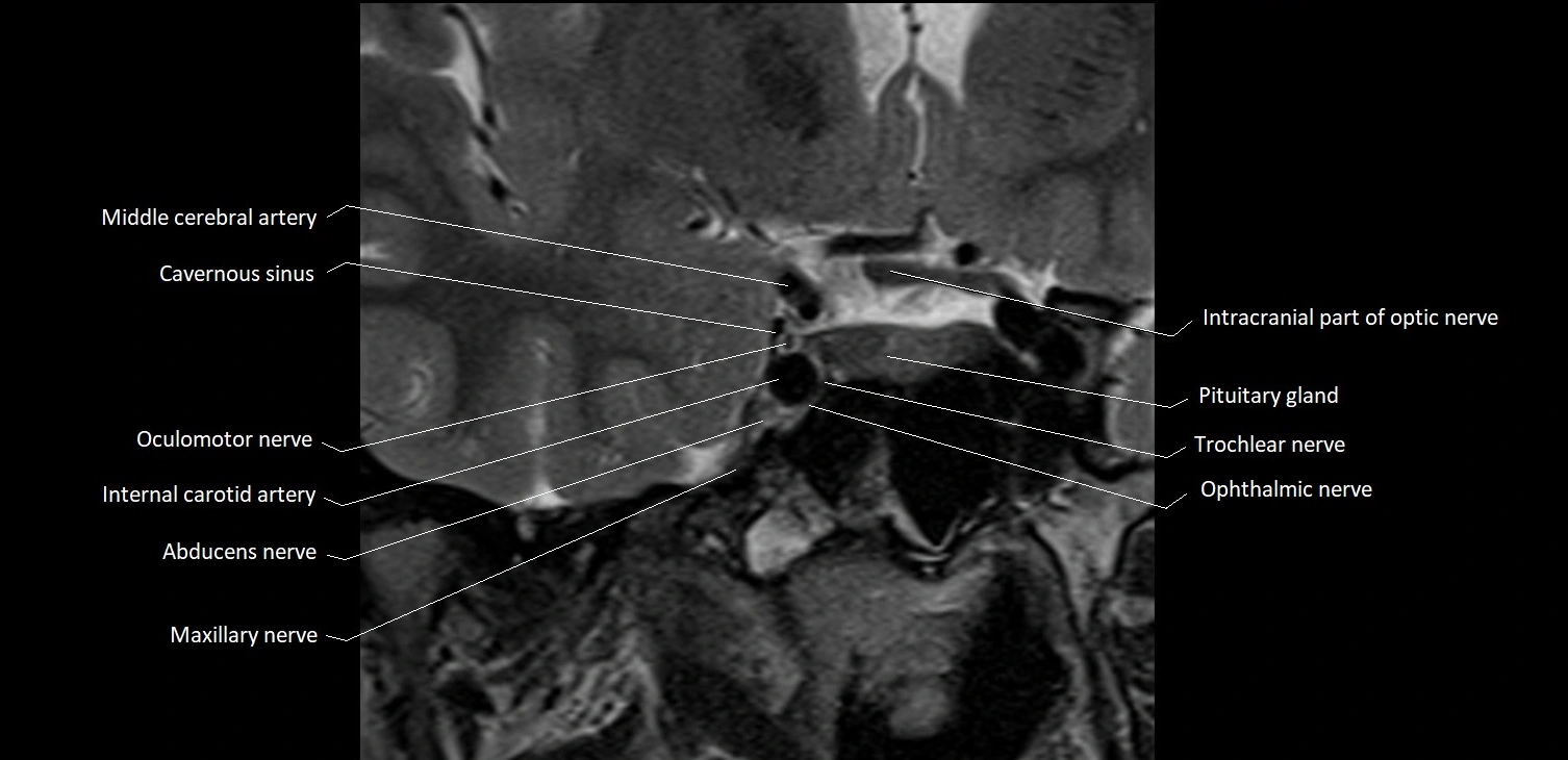MRI Orbit coronal cross sectional anatomy image 21.webp